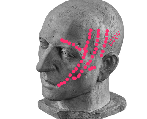 Temporalis pain referral pattern