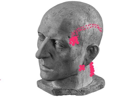 Upper trapezius pain referral pattern